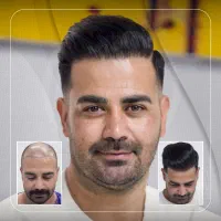 کاشت مو