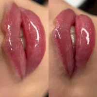فیلرلب،ژل،چونه،پی ارپی،جوانساز