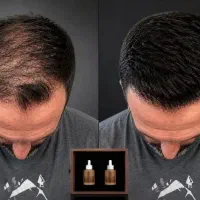 بالا بردن اعتماد به نفس به رویش ریشو مو