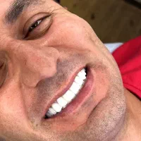 کامپوزیت/ایمپلنت/لمینت بااقساط ویژه