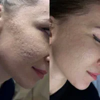 رفع تیرگی بدن رفع جای آکنه