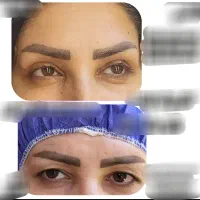 بوتاکس ژل لیفت نخ جراحی پلک چربی پی آرپی اندولیفت|خدمات زیبایی و سلامت|اصفهان, مولوی|دیوار