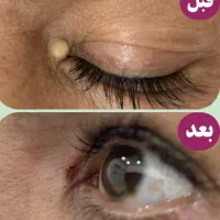 برداشتن تخصصی انواع خال،زگیل،میخچه با بهترین کیفیت