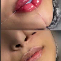 اموزش کامل ژل و بوتاکس به صورت تخصصی