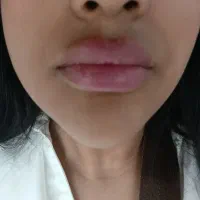 بمب تخفیف آموزش و خدمات فیلر و بوتاکس و مزو