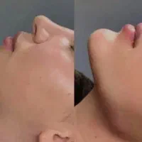 مدل برای تزریق ژل زیر نظر پزشک
