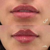 جشنواره فیلر و مزوژل بابل(پزشک متخصص از تهران)