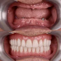 کاشت دندان دو فک فقط ۱۲۷ میلیون در تبریز