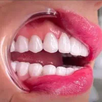 ‌کامپوزیت دندان  ۱۰م. عصب کشی ۱/۵ .ایمپلنت۲۰م