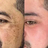 درمان تضمینی لک/کک و مک/ خال /فقط در 1جلسه