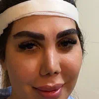میکروکاشت حرفه ای ابرو