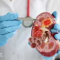 سنگ کلیه هاتو بنداز دور