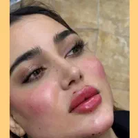 جشنواره تزریق ژل و بوتاکس وانزیم ومزو جوان سازی