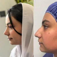 تغییر چهره و فرم بینی با رینوپلاستی پیشرفته