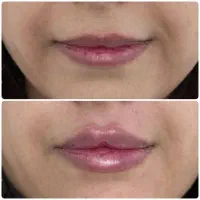 اموزش صفرتاصد زیبایی با ژل وبوتاکس و مزو