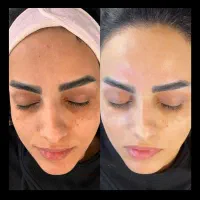 فشیال و پاکسازی و جوانسازی تخصصی پوست با دستگاه