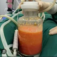ساکشن شکم و پهلو در مشهد10تا15بدون بیهوشی و جراحی