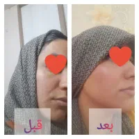 پک لایه بردار و روشن کننده اقتصادی و مقرون به صرفه