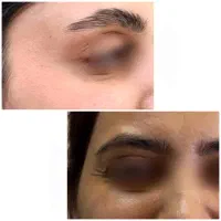 بوتاکس توسط پزشک با تخفیف ویژه فقط تا ۳۱ تیر