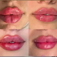 ژل وبوتاکس صورت وبدن