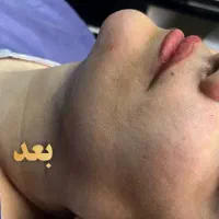 ساکشن غبغب زاویه‌سازی فک و صورت . دکتر واحدی