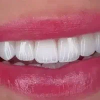 عصبکشی روکش کامپوزیت دندانپزشکی چیتگر آزادی صادقیه