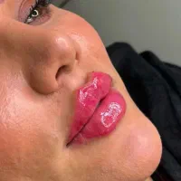 آموزش ژل و بوتاکس