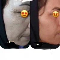 چروک صورت