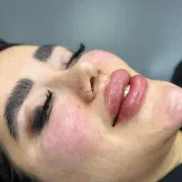 ژل و بوتاکس فقط ۸۰۰