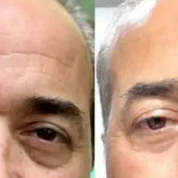 خودت بوتاکس و لیفت رو در منزل انجام بده