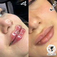 تزریق و آموزش هیپ دیپ ژل بوتاکس جوانساز