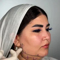 ساکشن غبغب بدون جراحی زاویه فک وی لاین