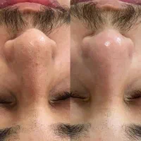 پاکسازی پوست/فیشیال صورت آقایان