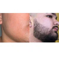 نانوکیت ریش