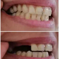 دندانسازی مروارید  جنس ژاپنی 20 میلیون
