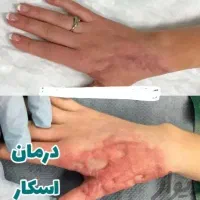 لیزر جای بخیه، جوش، آکنه ، اسکار سوختگی و خودزنی