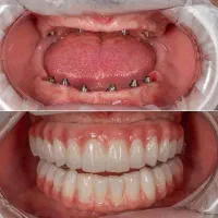 ایمپلنت در تبریز دندانپزشکی ارتودنسی روکش