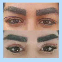 بلفاروپلاستی ساده ۵/۵،خدمات زیبایی  مربوط به صورت