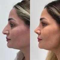 جراحی تخصصی بینی /پیکرتراشی / سینه