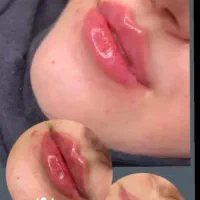 تزریق فیلروبوتاکس وچربی لیفت شقیقه مینی لیفت صورت