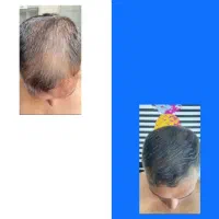 رشد مو قدم به قدم تا به نتیجه