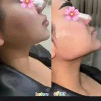 فیلر سی سی ۹۵۰بوتاکس۱۵۰۰