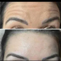 اموزش ژل بوتاکس انزیم