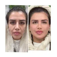 جشنوارلیفت/جوانسازی/هایفو/فقط1جلسه باهدیه رایگان