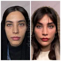 فیلر بوتاکس دکتر پرهام تبریزی کاشت مو ژل لب بینی