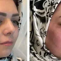 جشنواره تابستانه تزریق چربی ،نانوفت ،svf