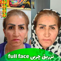 فیلر بادی، جراحی سرپایی زیبایی حجم دهی صورت بدن|خدمات آرایشگری و زیبایی|مرودشت, رودبال|دیوار