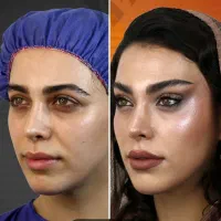 فرمدهی بینی Noa بدون عملDrپوست مو ابرو غبغب زیبایی