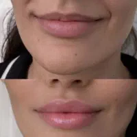 جشنواره تزریق ژل لب تکنیکM بوتاکس و انزیم وپیرسینگ