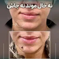 انواع خال از ۵۰ تا ۱۰۰
